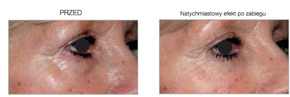 Korekta okolicy kurzych lapek <?echo $add_image;?>