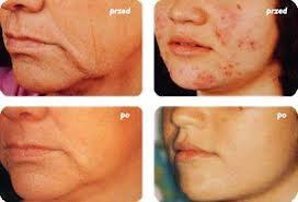 przed i po cyklu zabiegów <?echo $add_image;?>