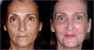 spektakularne efekty terapii łączonej, w tym cyklu peelingów  <?echo $add_image;?>