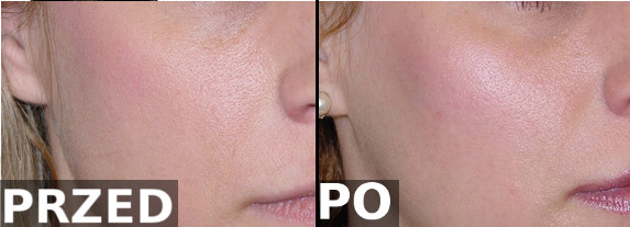 Korekta okolicy jarzmowej  <?echo $add_image;?>