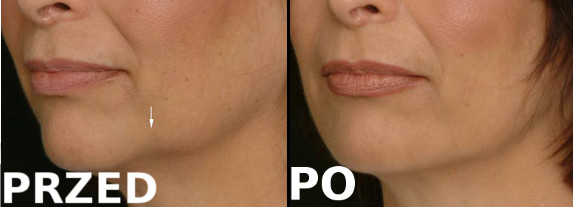 Modelowanie linii żuchwy.  <?echo $add_image;?>