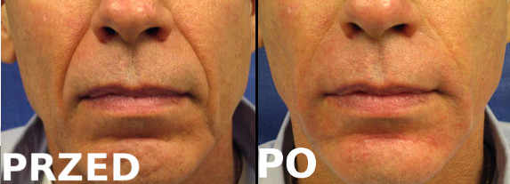 Usunięcie brózd nosowo-wargowych  <?echo $add_image;?>