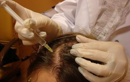 Zabieg mezoterapii skóry głowy <?echo $add_image;?>